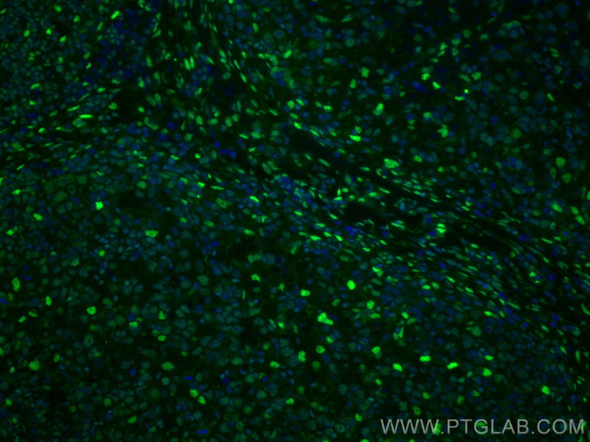 Immunofluorescence (IF) / fluorescent staining of human lymphoma tissue using FTO Polyclonal antibody (27226-1-AP)