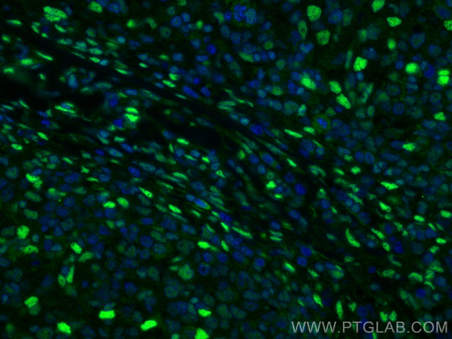 Immunofluorescence (IF) / fluorescent staining of human lymphoma tissue using FTO Polyclonal antibody (27226-1-AP)