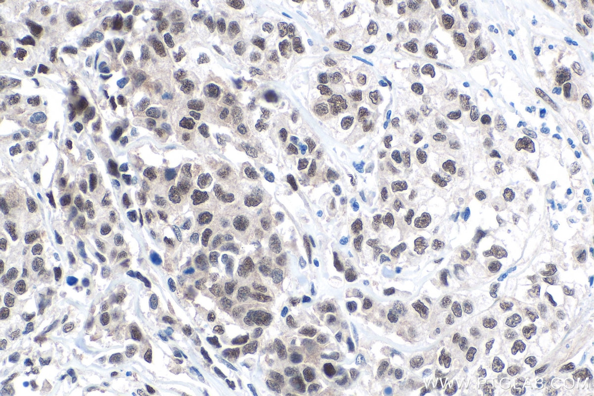 IHC staining of human stomach cancer using 27226-1-AP