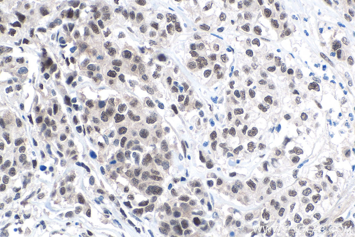 Immunohistochemistry (IHC) staining of human stomach cancer tissue using FTO Polyclonal antibody (27226-1-AP)