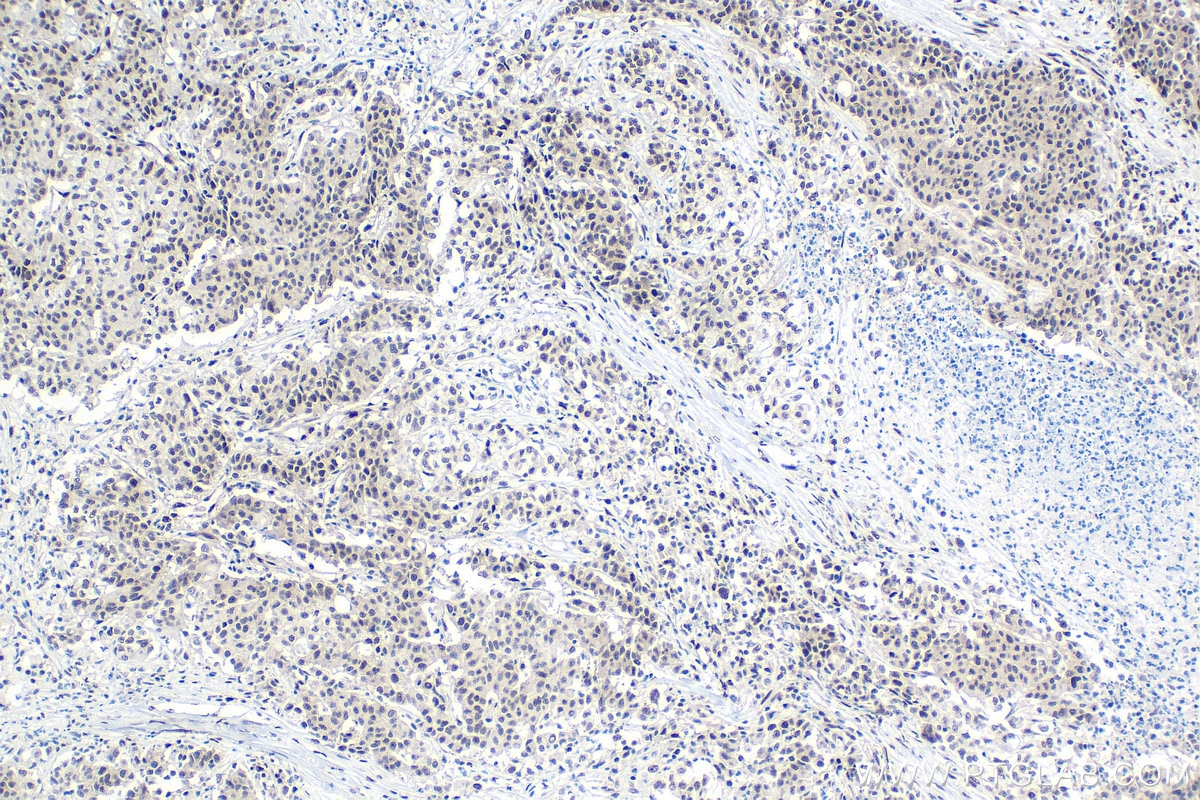 Immunohistochemistry (IHC) staining of human stomach cancer tissue using FTO Polyclonal antibody (27226-1-AP)