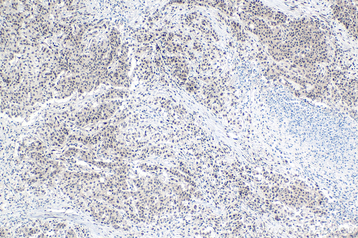 IHC staining of human stomach cancer using 27226-1-AP