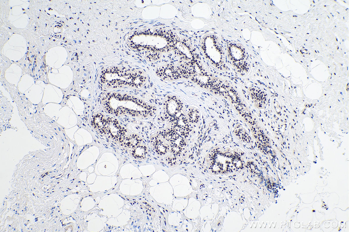 Immunohistochemistry (IHC) staining of human breast cancer tissue using FTO Polyclonal antibody (27226-1-AP)