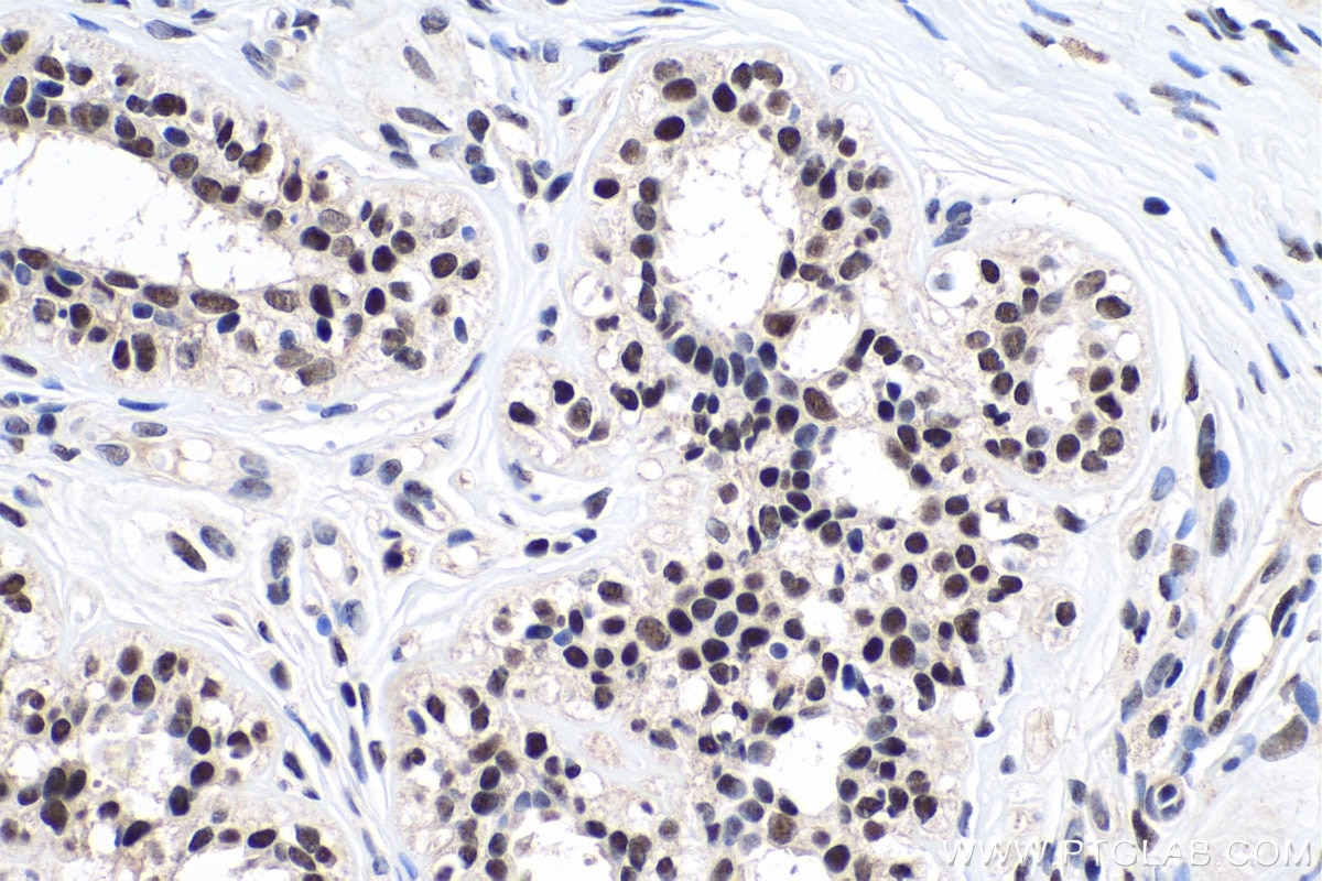 Immunohistochemistry (IHC) staining of human breast cancer tissue using FTO Polyclonal antibody (27226-1-AP)