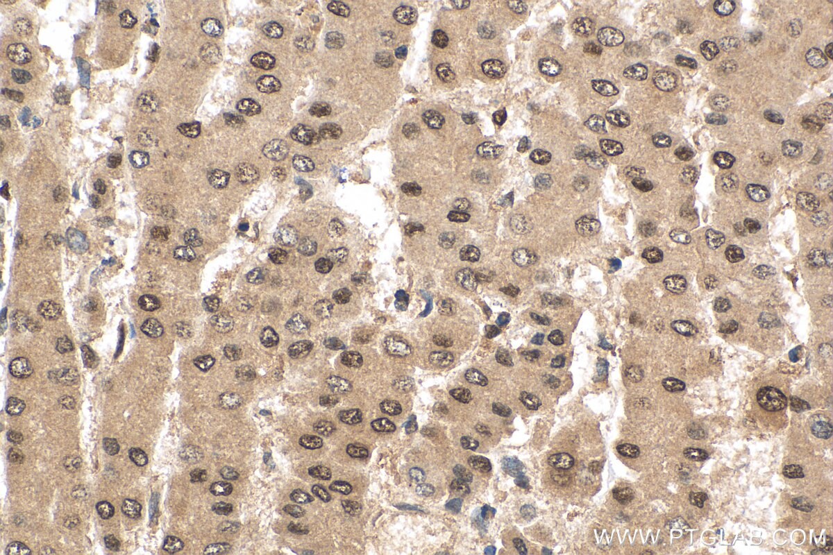 IHC staining of human liver cancer using 27226-1-AP