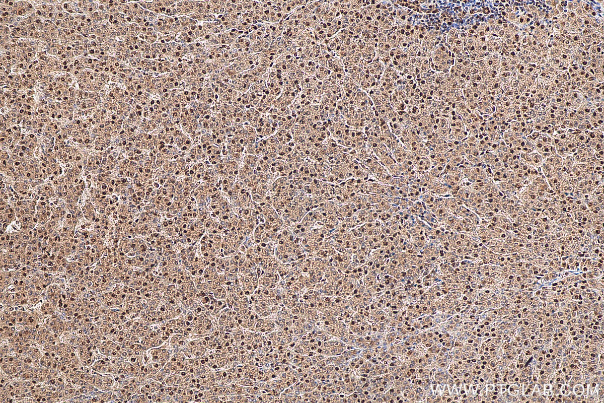 Immunohistochemistry (IHC) staining of human liver cancer tissue using FTO Polyclonal antibody (27226-1-AP)