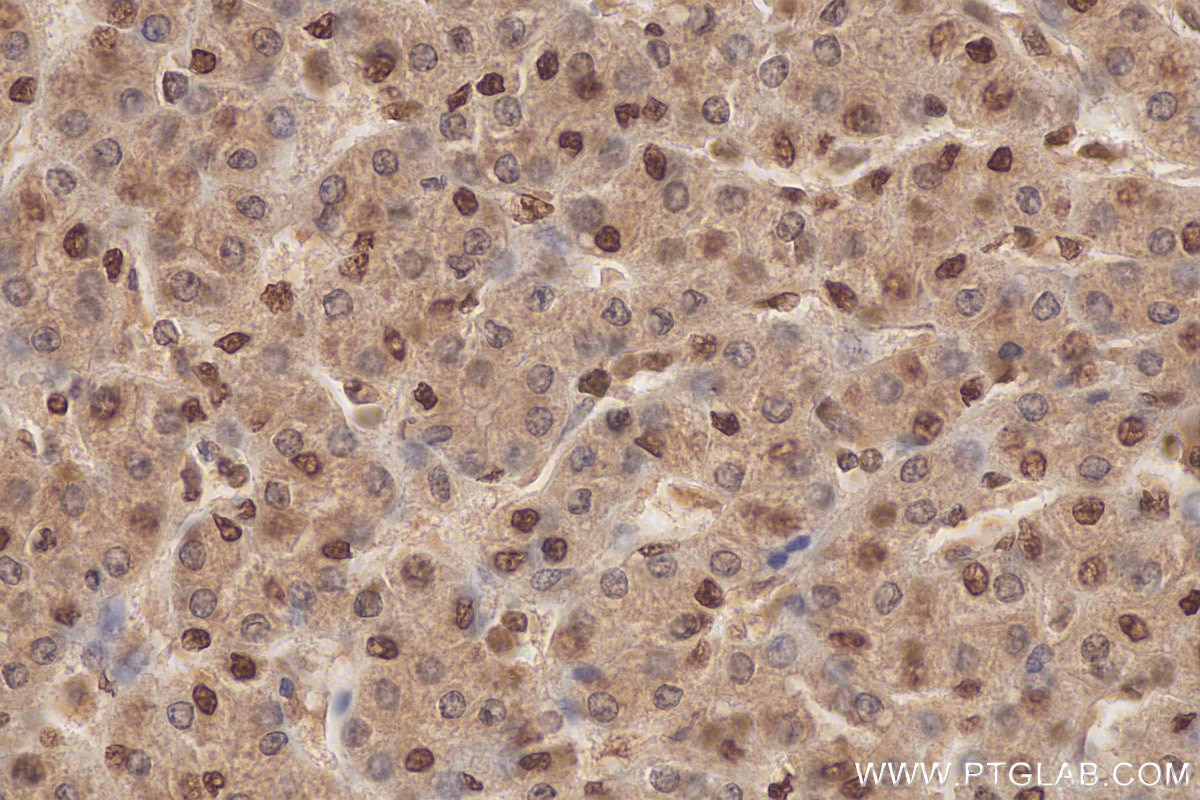 Immunohistochemistry (IHC) staining of human liver cancer tissue using FTO Polyclonal antibody (27226-1-AP)