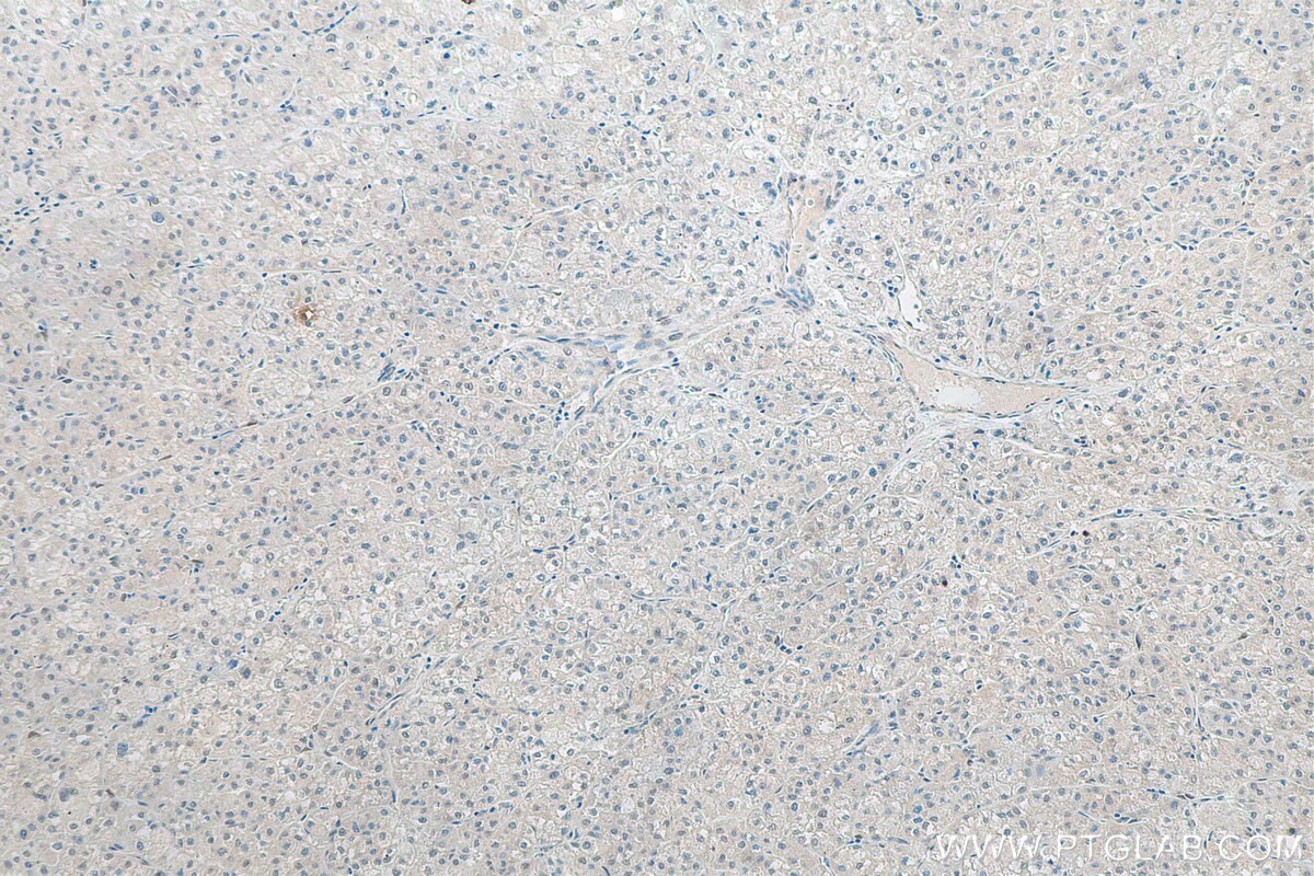 Immunohistochemistry (IHC) staining of human liver cancer tissue using FTO Monoclonal antibody (68111-1-Ig)