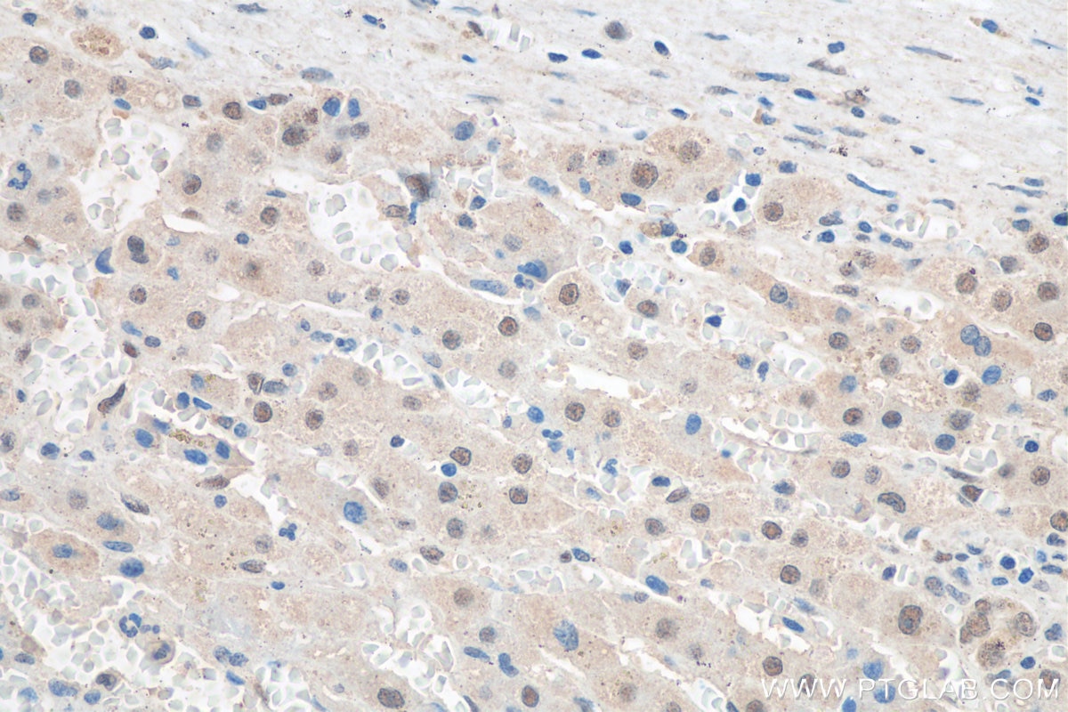Immunohistochemistry (IHC) staining of human liver cancer tissue using FTO Monoclonal antibody (68111-1-Ig)