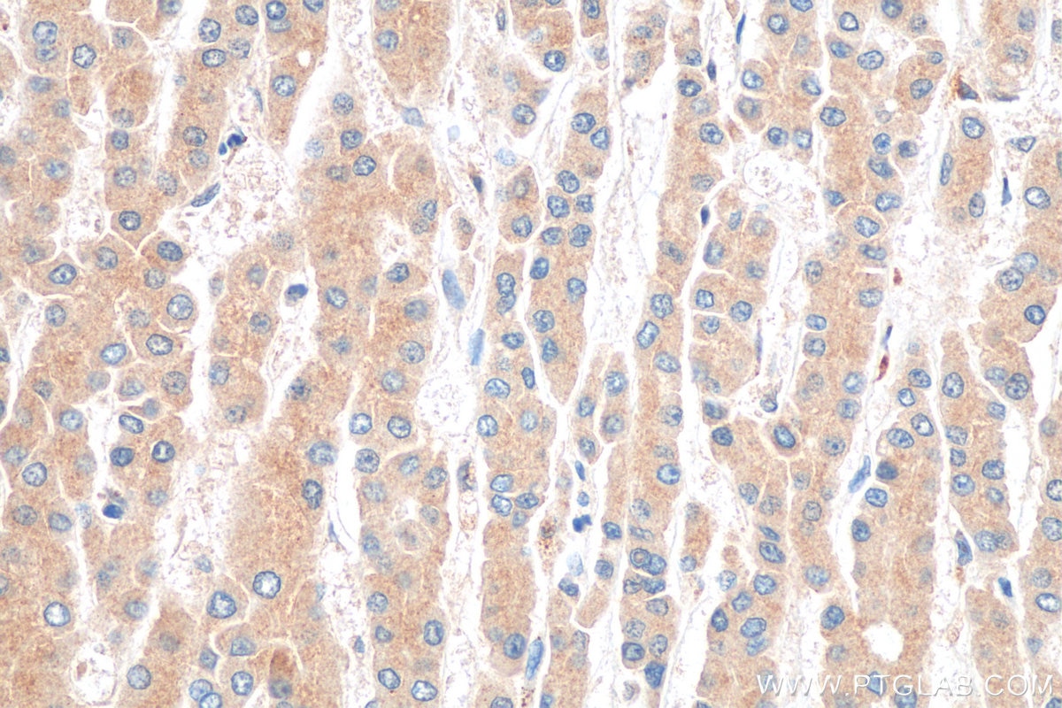 IHC staining of human liver cancer using 81471-1-RR