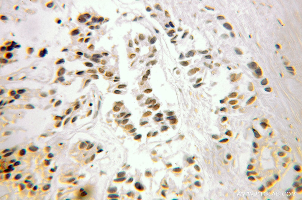 Immunohistochemistry (IHC) staining of human prostate cancer tissue using FUBP3 Polyclonal antibody (10623-1-AP)