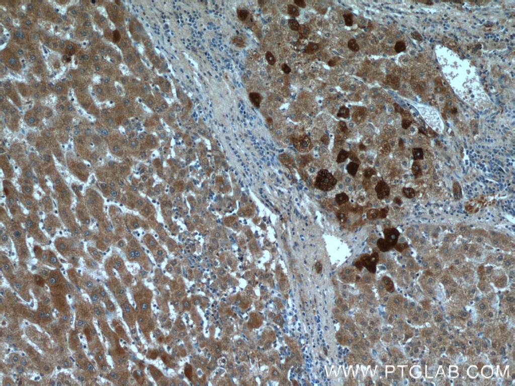 Immunohistochemistry (IHC) staining of human liver cancer tissue using FUCA1 Polyclonal antibody (16420-1-AP)