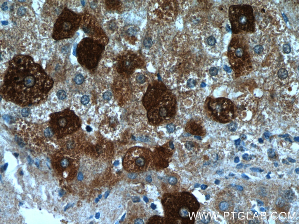 Immunohistochemistry (IHC) staining of human liver cancer tissue using FUCA1 Polyclonal antibody (16420-1-AP)