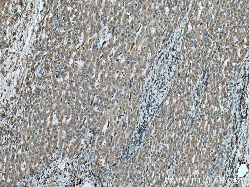 IHC staining of human liver cancer using 67251-1-Ig