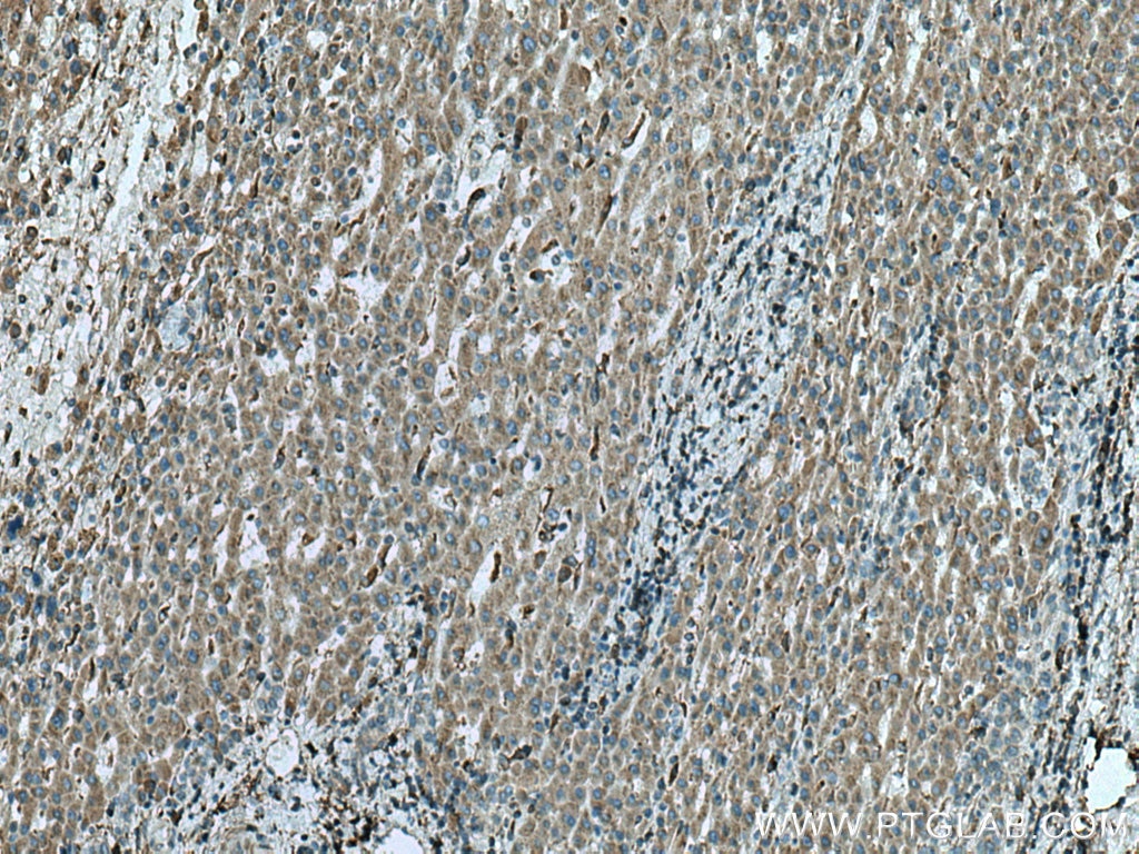 Immunohistochemistry (IHC) staining of human liver cancer tissue using FUCA1 Monoclonal antibody (67251-1-Ig)