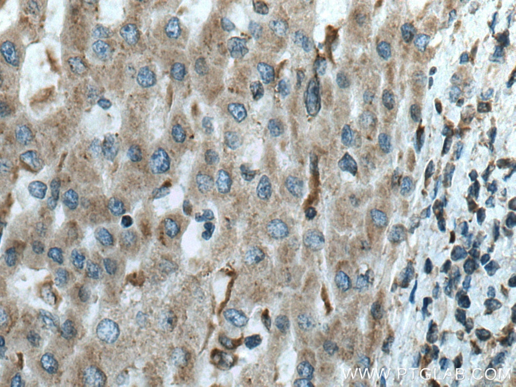 Immunohistochemistry (IHC) staining of human liver cancer tissue using FUCA1 Monoclonal antibody (67251-1-Ig)