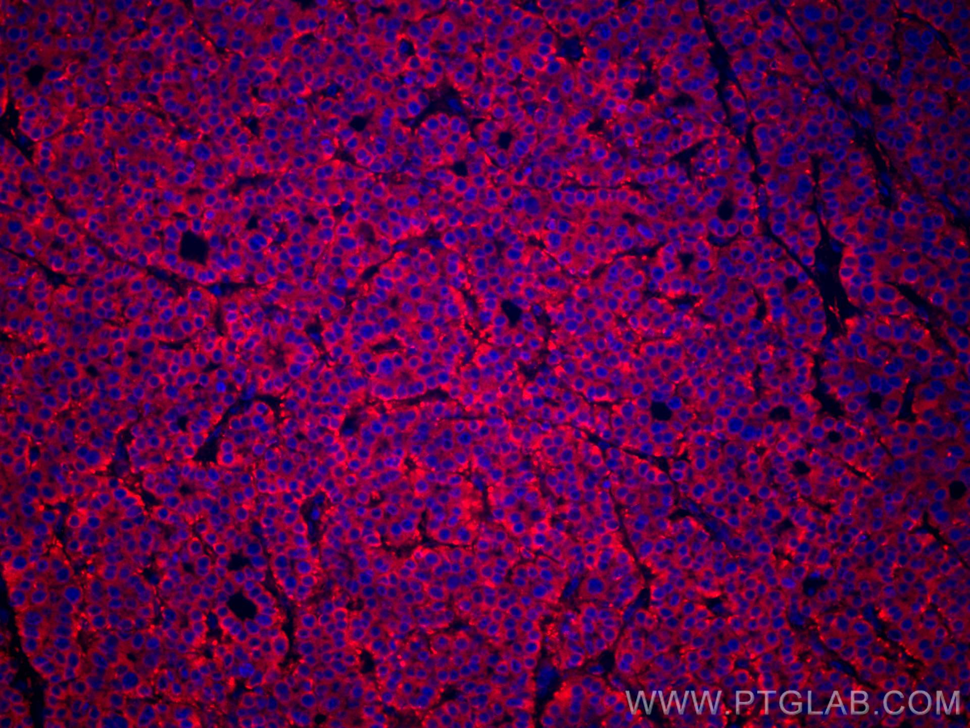Immunofluorescence (IF) / fluorescent staining of human liver cancer tissue using CoraLite®594-conjugated FUCA1 Monoclonal antibody (CL594-67251)