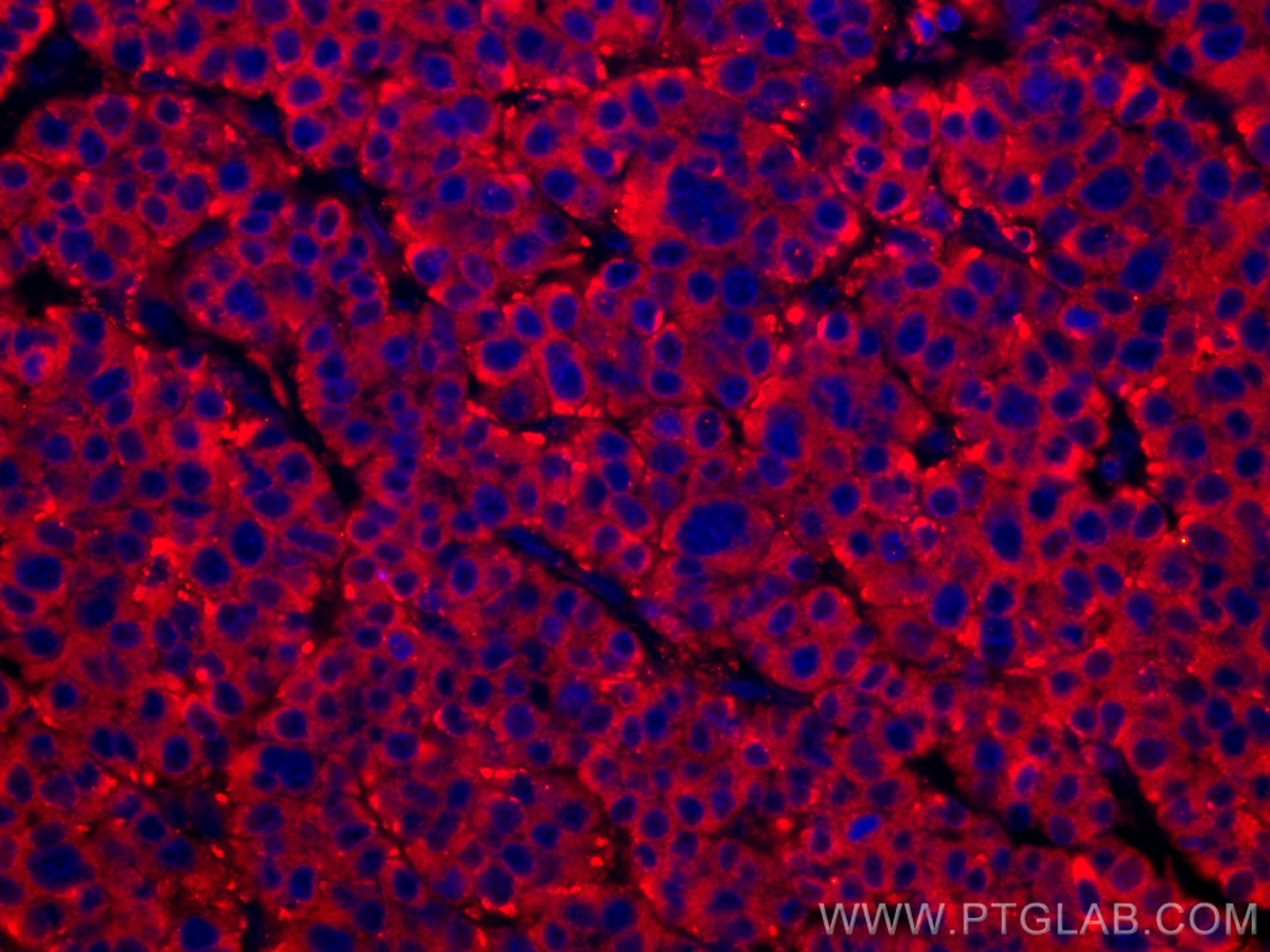 Immunofluorescence (IF) / fluorescent staining of human liver cancer tissue using CoraLite®594-conjugated FUCA1 Monoclonal antibody (CL594-67251)