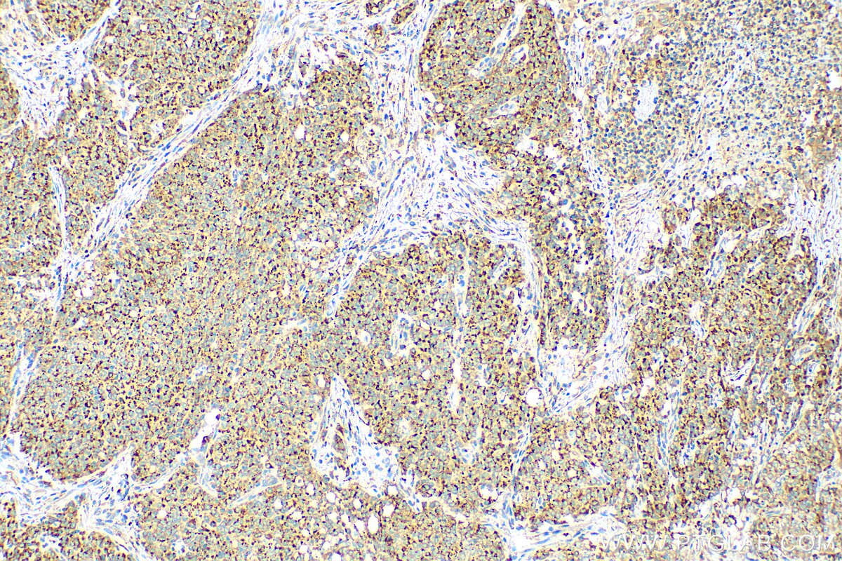 Immunohistochemistry (IHC) staining of human stomach cancer tissue using FUCA2 Polyclonal antibody (30080-1-AP)
