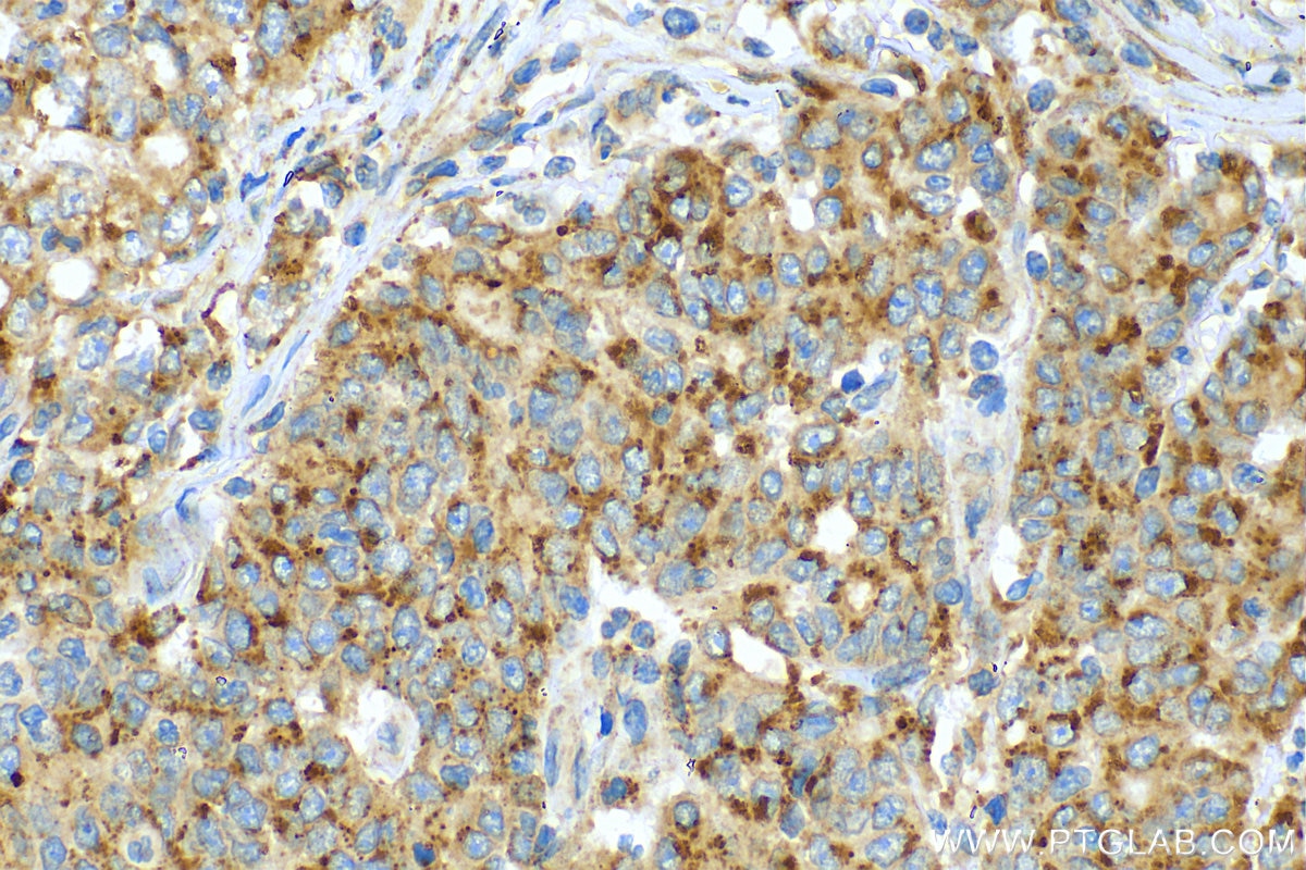 Immunohistochemistry (IHC) staining of human stomach cancer tissue using FUCA2 Polyclonal antibody (30080-1-AP)