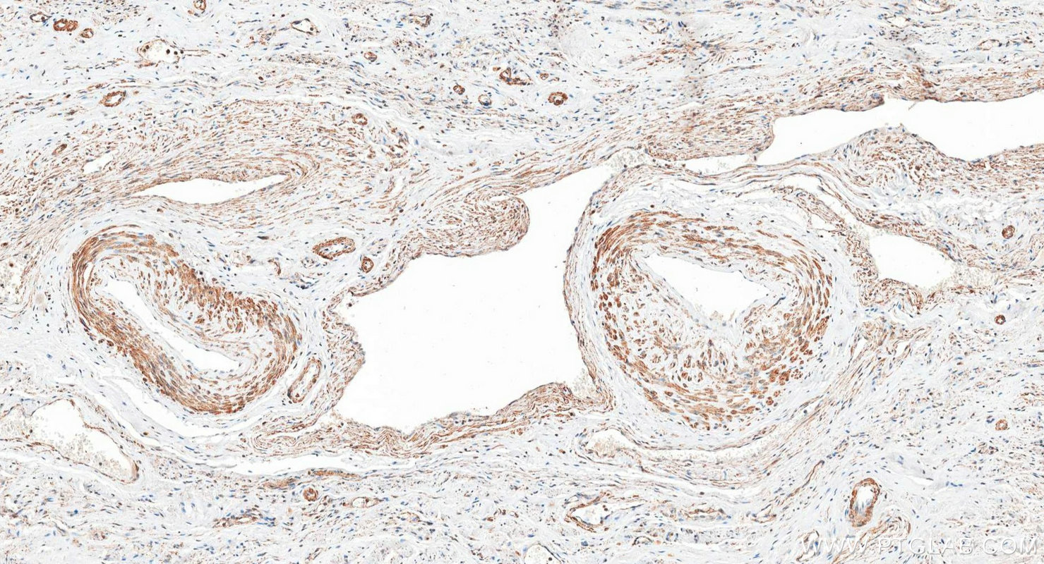 Immunohistochemistry (IHC) staining of human cervical cancer tissue using FUNDC1 Polyclonal antibody (28519-1-AP)