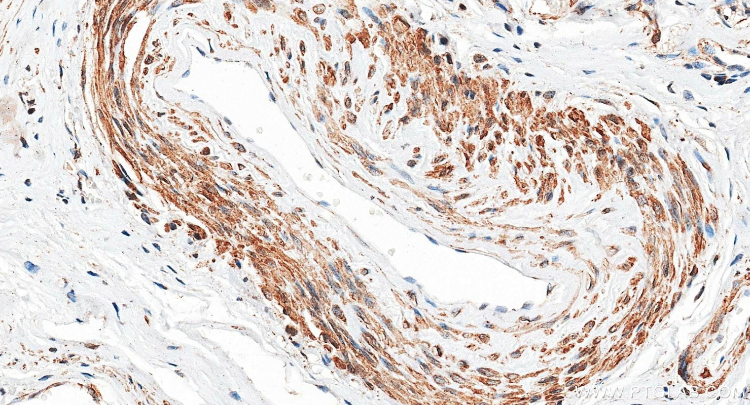 Immunohistochemistry (IHC) staining of human cervical cancer tissue using FUNDC1 Polyclonal antibody (28519-1-AP)