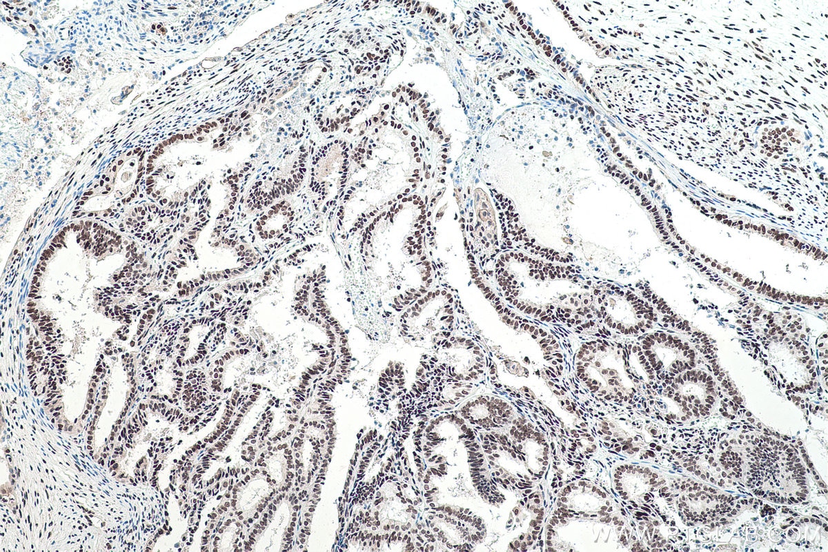 IHC staining of human ovary tumor using 11570-1-AP Immunohistochemistry (IHC) staining of human ovary tumor tissue using FUS/TLS Polyclonal antibody (11570-1-AP)