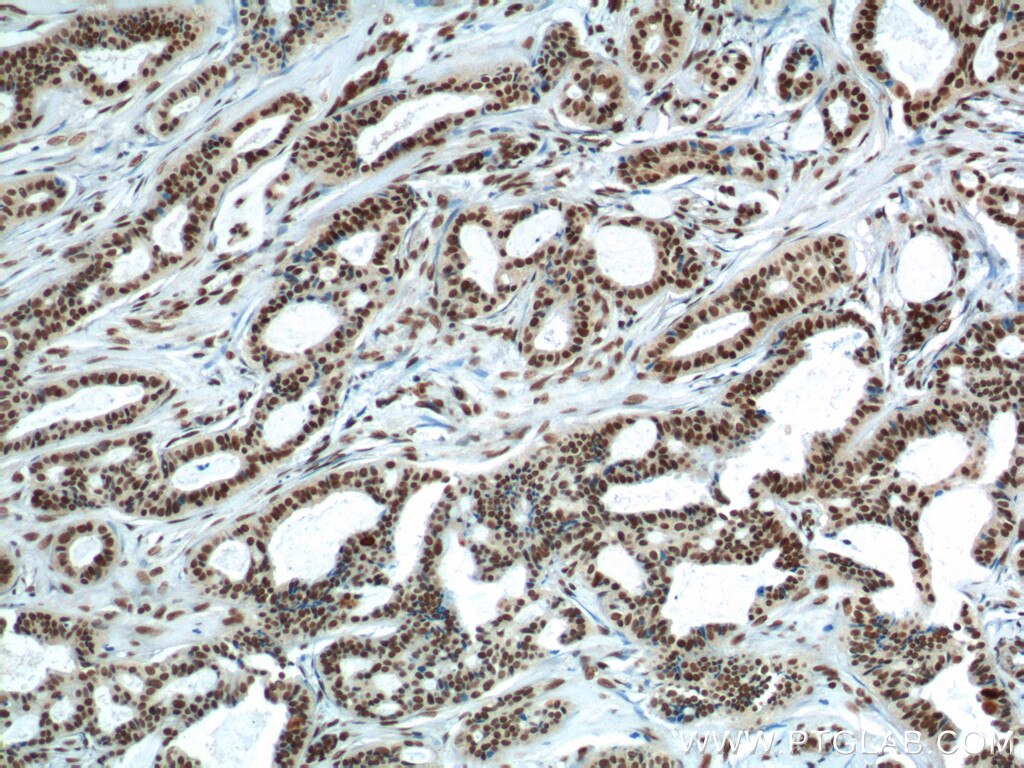 IHC staining of human breast cancer using 11570-1-AP