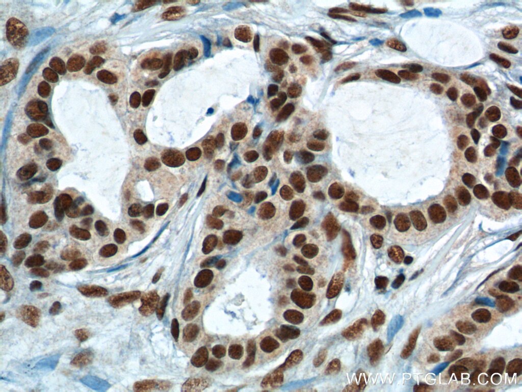 IHC staining of human breast cancer using 11570-1-AP