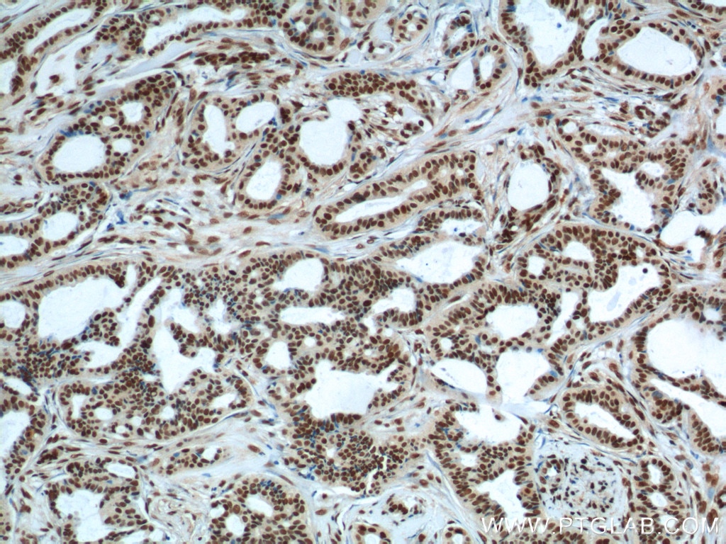 Immunohistochemistry (IHC) staining of human breast cancer tissue using FUS/TLS Polyclonal antibody (11570-1-AP)