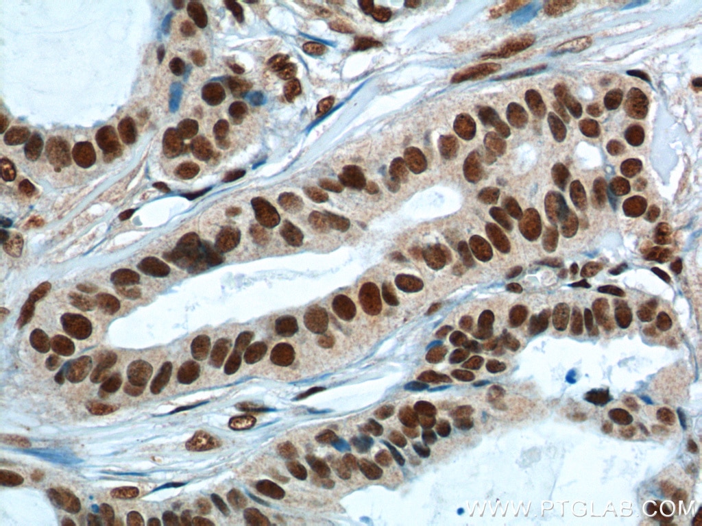 IHC staining of human breast cancer using 11570-1-AP