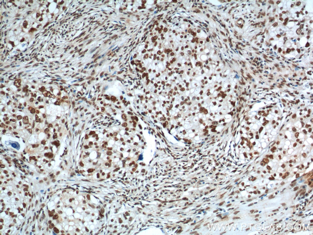 IHC staining of human ovary tumor using 11570-1-AP