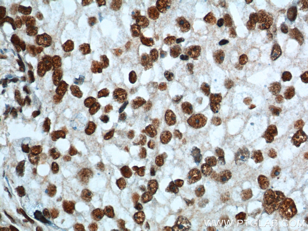 Immunohistochemistry (IHC) staining of human ovary tumor tissue using FUS/TLS Polyclonal antibody (11570-1-AP)