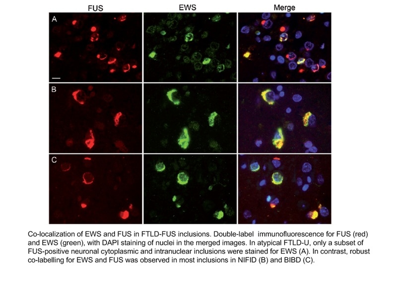 Immunofluorescence (IF) / fluorescent staining of human brain(ALS) tissue using FUS/TLS Monoclonal antibody (60160-1-Ig)
