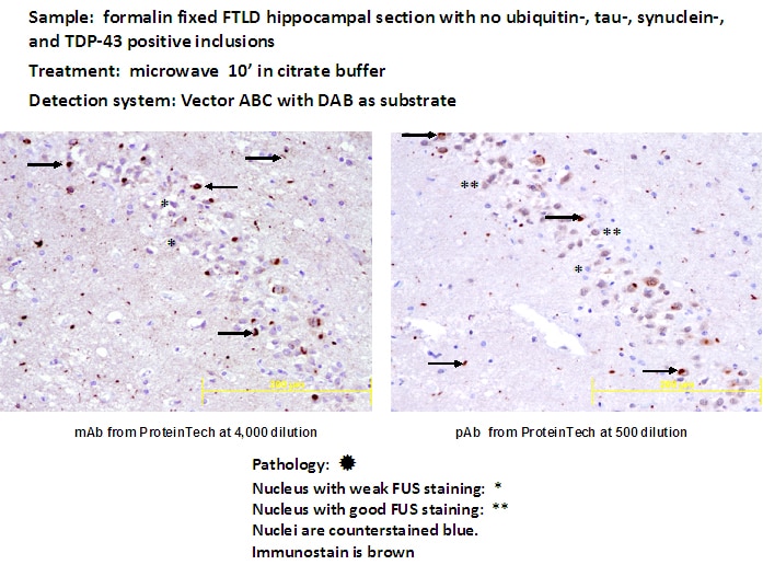 Immunohistochemistry (IHC) staining of human brain (FTLD) tissue using FUS/TLS Monoclonal antibody (60160-1-Ig)