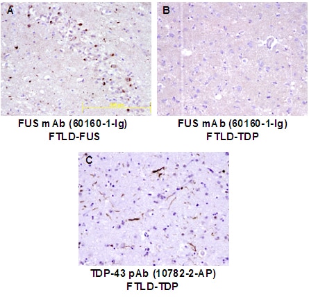 Immunohistochemistry (IHC) staining of human brain (FTLD) tissue using FUS/TLS Monoclonal antibody (60160-1-Ig)
