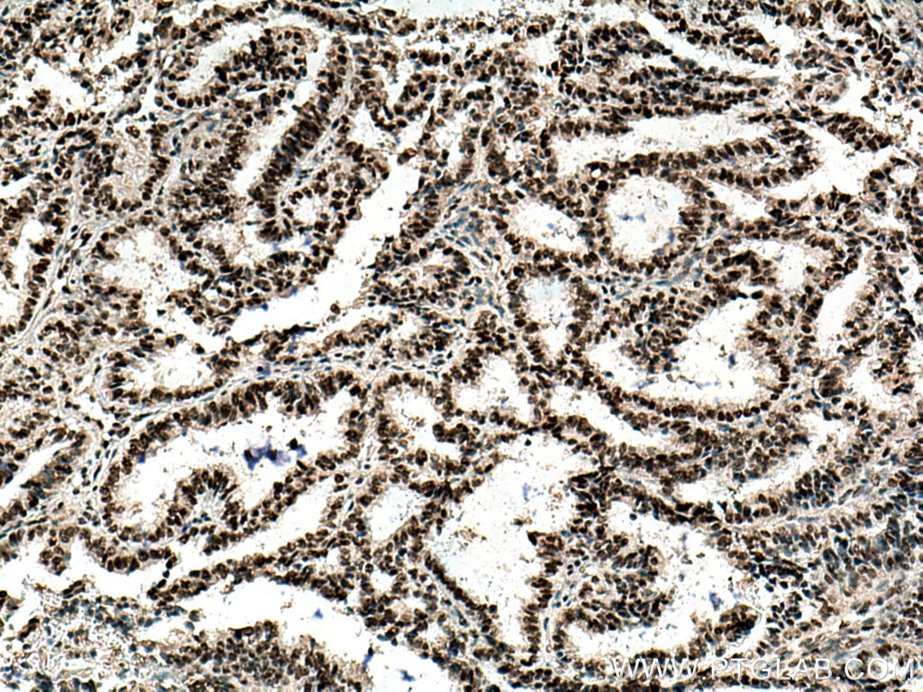 Immunohistochemistry (IHC) staining of human ovary tumor tissue using FUS/TLS Monoclonal antibody (60160-1-Ig)