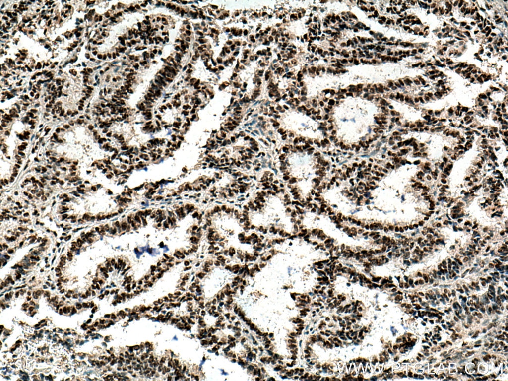 IHC staining of human ovary tumor using 60160-1-Ig