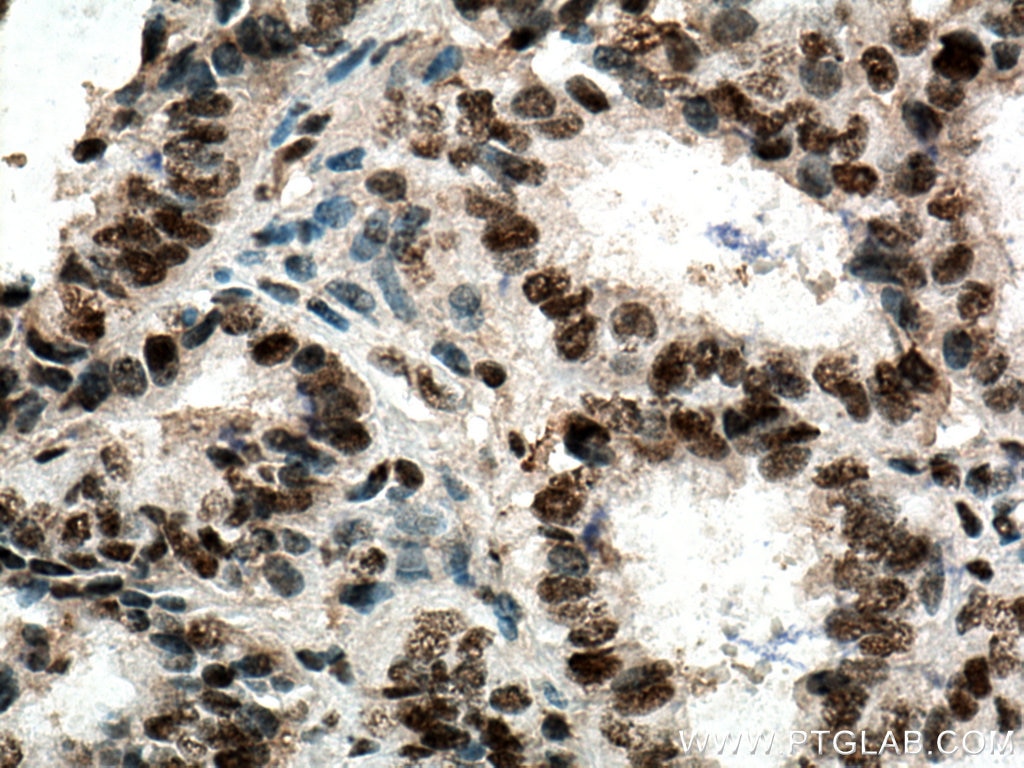 Immunohistochemistry (IHC) staining of human ovary tumor tissue using FUS/TLS Monoclonal antibody (60160-1-Ig)