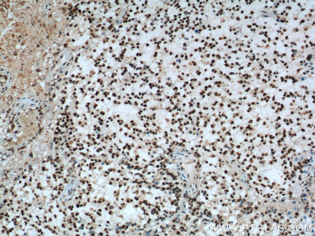 Immunohistochemistry (IHC) staining of human gliomas tissue using FUS/TLS Monoclonal antibody (60160-1-Ig)