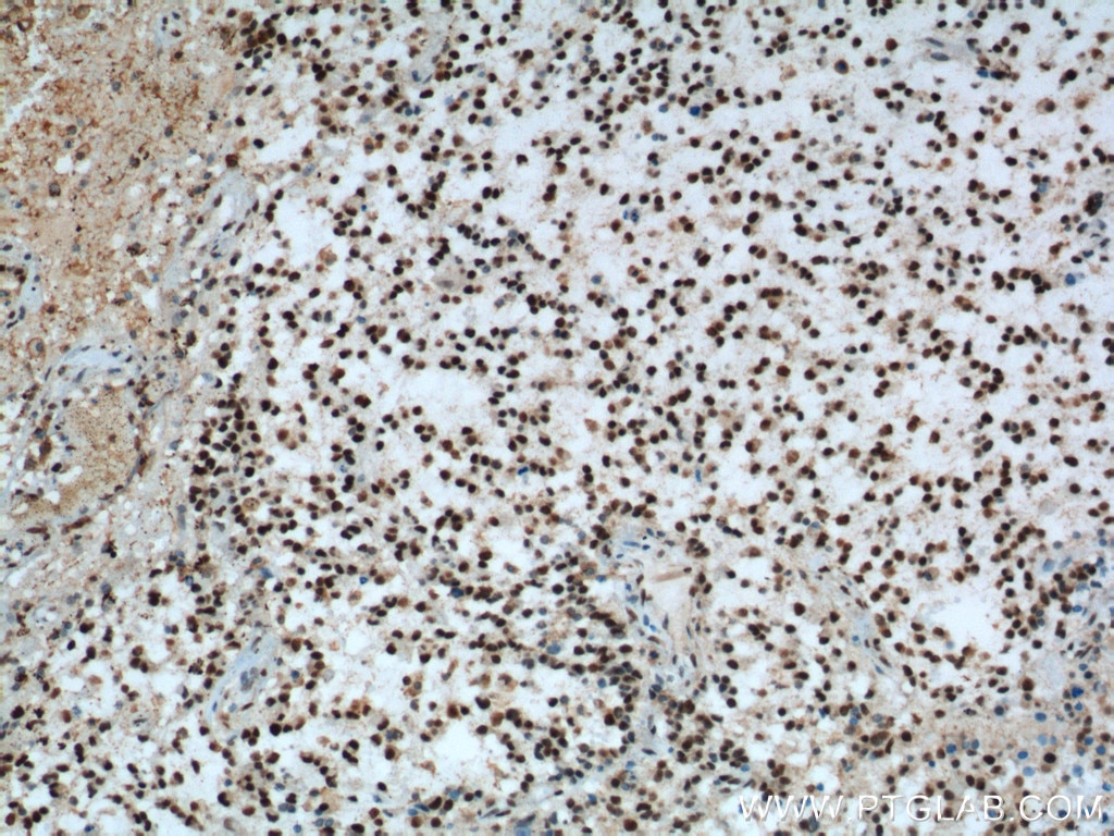 IHC staining of human gliomas using 60160-1-Ig