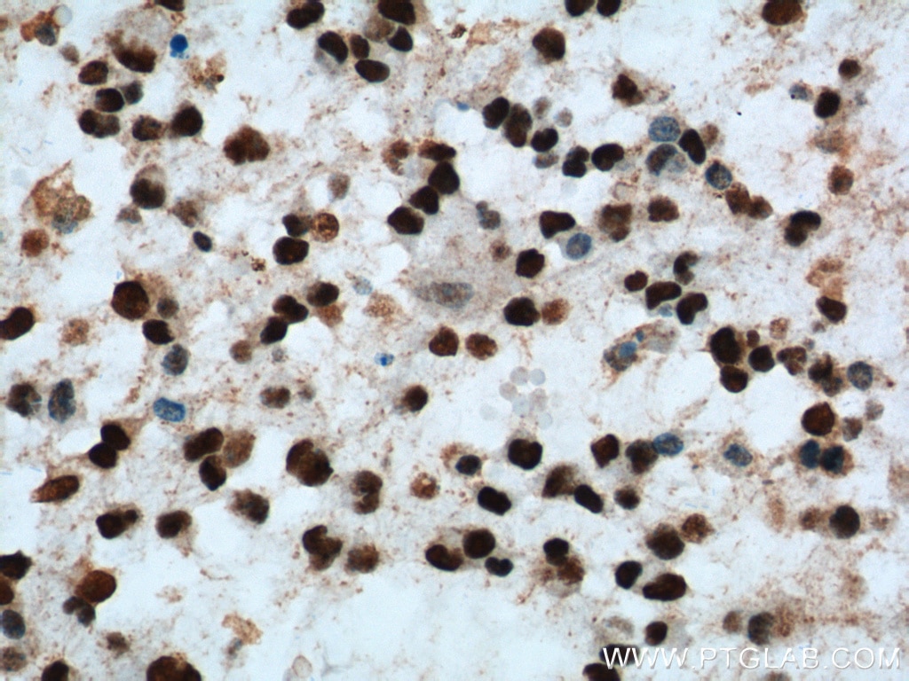 IHC staining of human gliomas using 60160-1-Ig