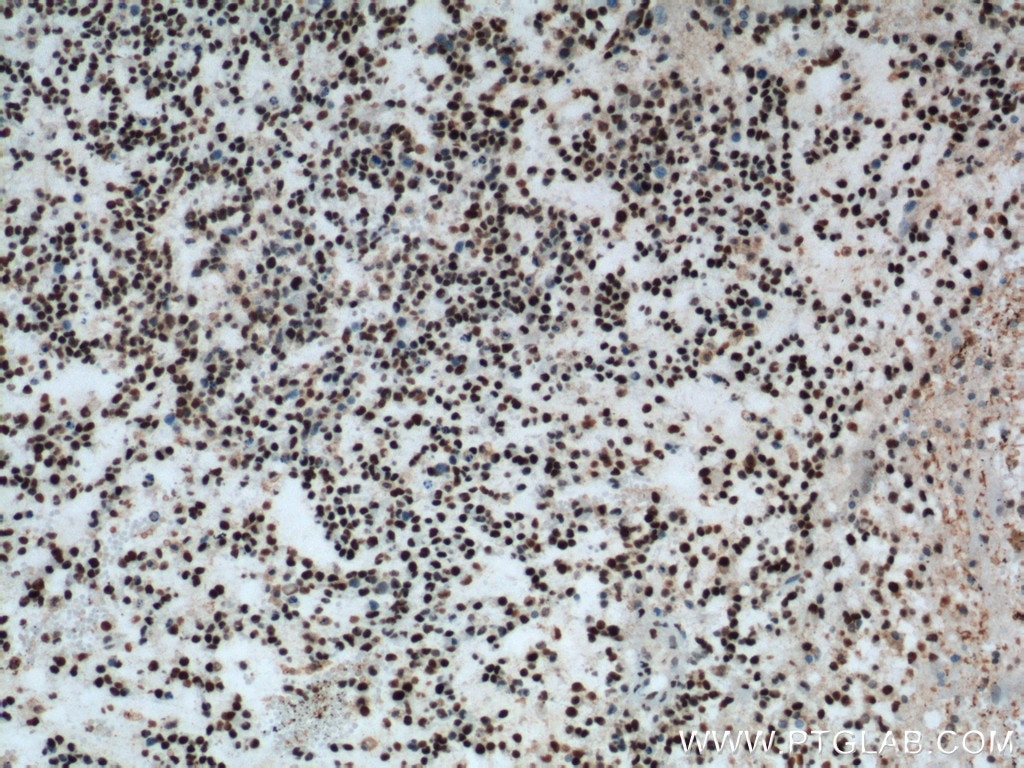 Immunohistochemistry (IHC) staining of human gliomas tissue using FUS/TLS Monoclonal antibody (60160-1-Ig)