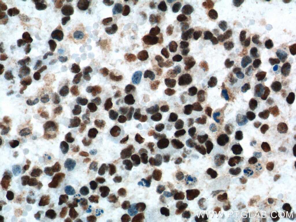 IHC staining of human gliomas using 60160-1-Ig