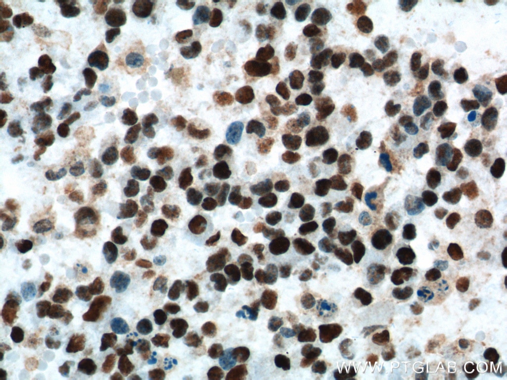 Immunohistochemistry (IHC) staining of human gliomas tissue using FUS/TLS Monoclonal antibody (60160-1-Ig)