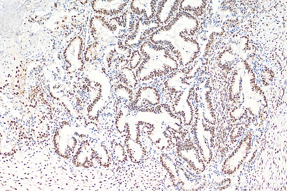 IHC staining of human ovary tumor using 68262-1-Ig
