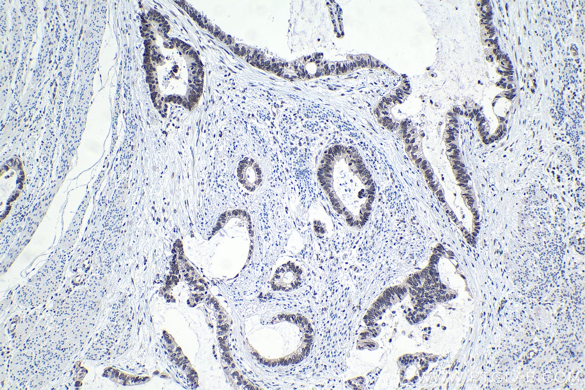 Immunohistochemistry (IHC) staining of human urothelial carcinoma tissue using FUSIP1 Polyclonal antibody (10131-1-AP)