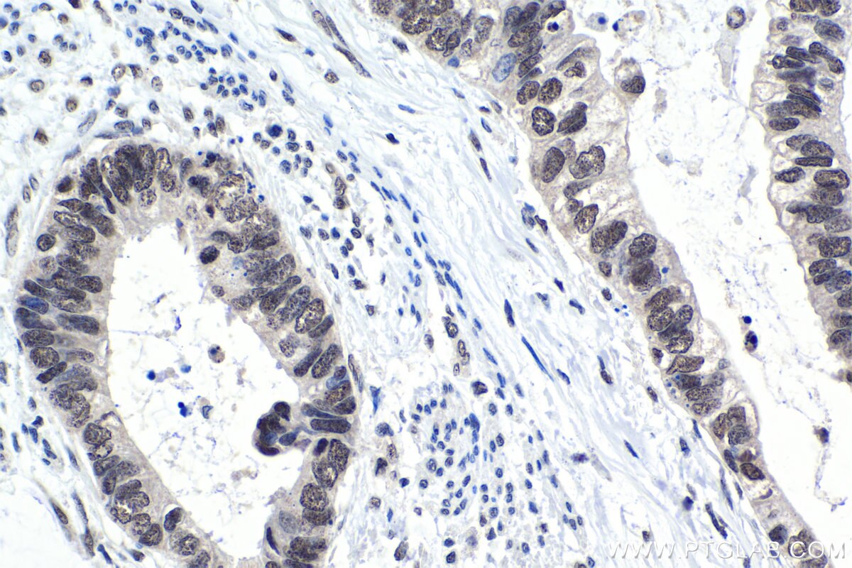 Immunohistochemistry (IHC) staining of human urothelial carcinoma tissue using FUSIP1 Polyclonal antibody (10131-1-AP)