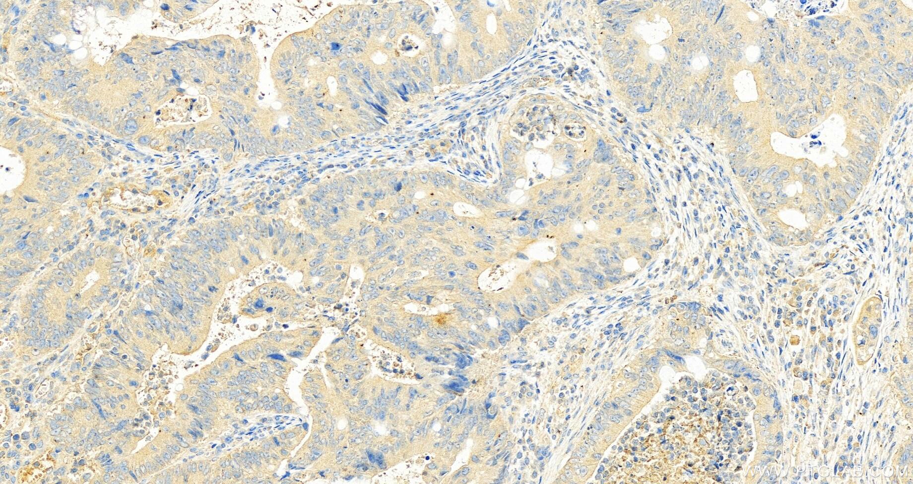 Immunohistochemistry (IHC) staining of human colon cancer tissue using FUT3 Monoclonal antibody (67344-1-Ig)