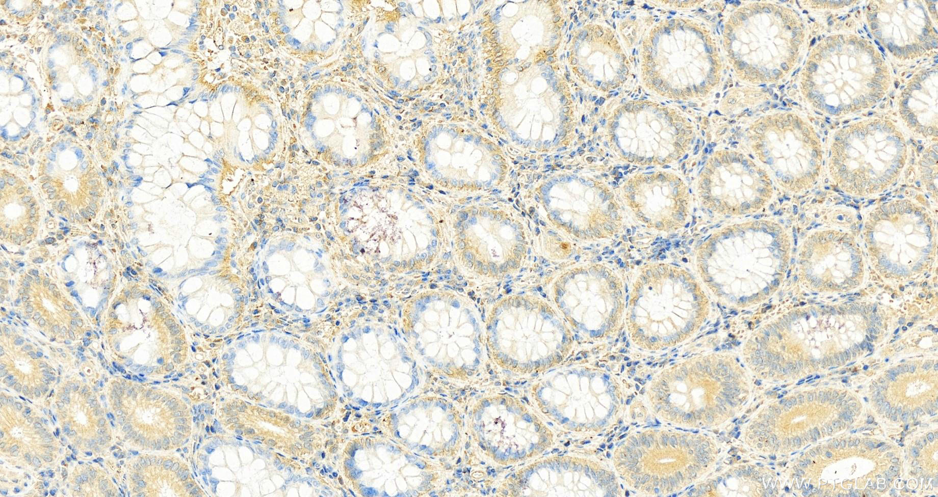 Immunohistochemistry (IHC) staining of human colon cancer tissue using FUT3 Monoclonal antibody (67344-1-Ig)